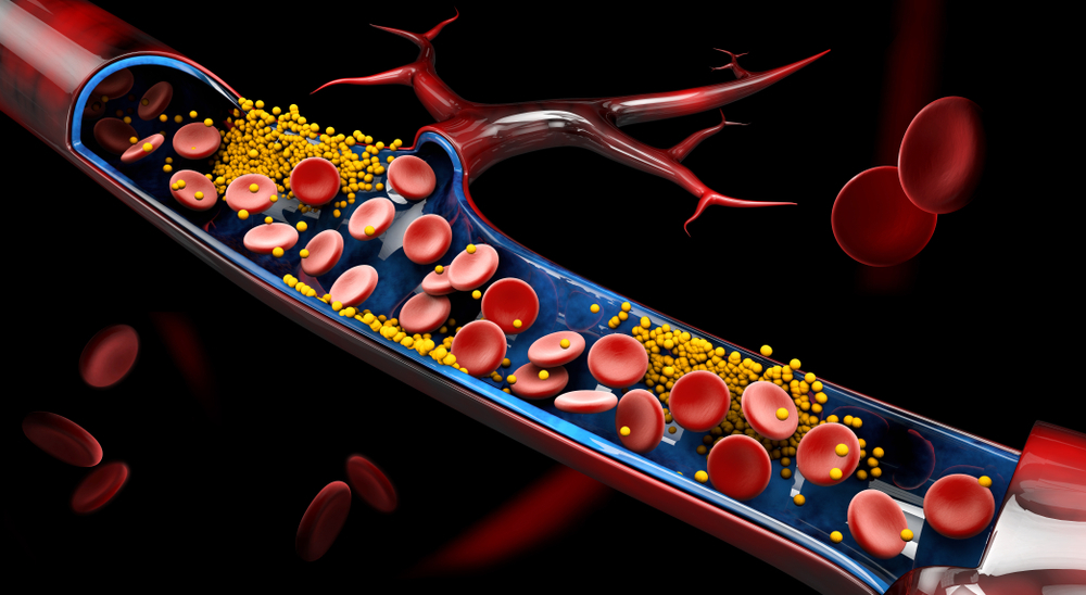 What is Cholesterol and How Does Too Much of It Affect Your Health?