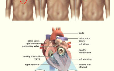 Discover the Benefits of Minimally Invasive Mitral Valve Replacement Surgery: A New Hope for Heart Disease Patients