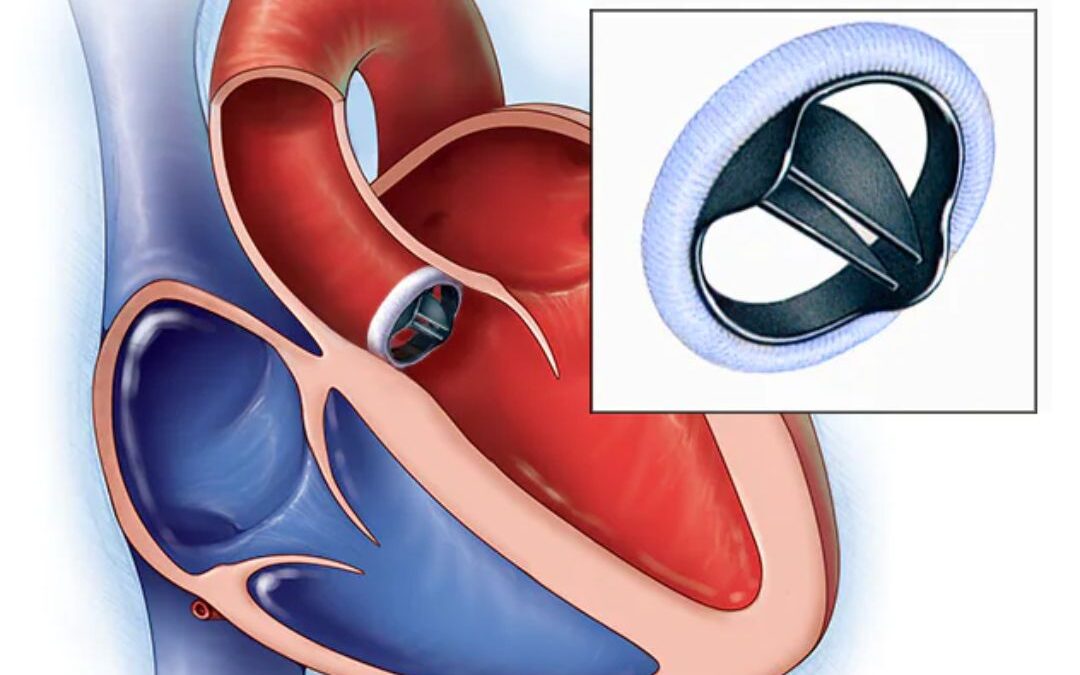 Heart valve disease: signs, symptoms, complications, treatment options.