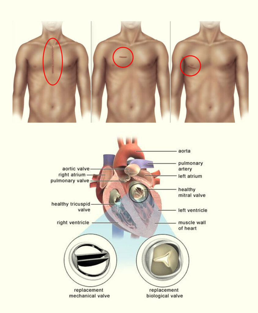 Valve Replacement Surgery